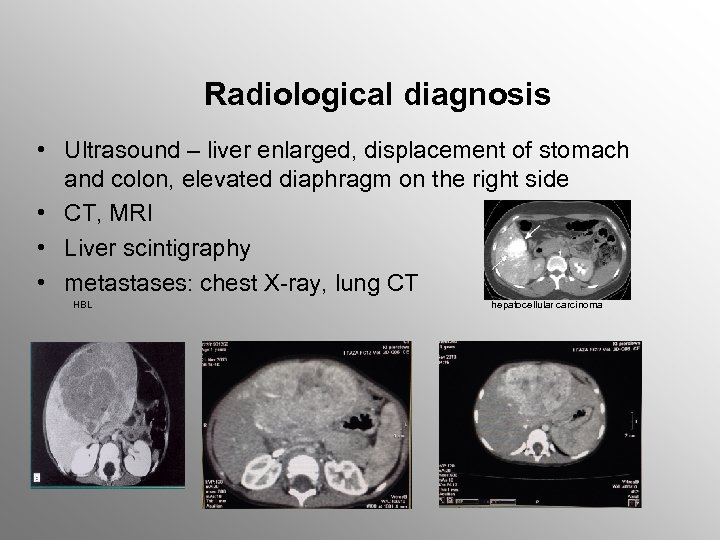 Radiological diagnosis • Ultrasound – liver enlarged, displacement of stomach and colon, elevated diaphragm