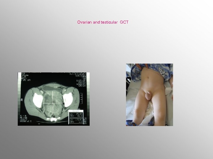 Ovarian and testicular GCT 