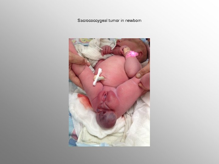 Sacrococcygeal tumor in newborn 