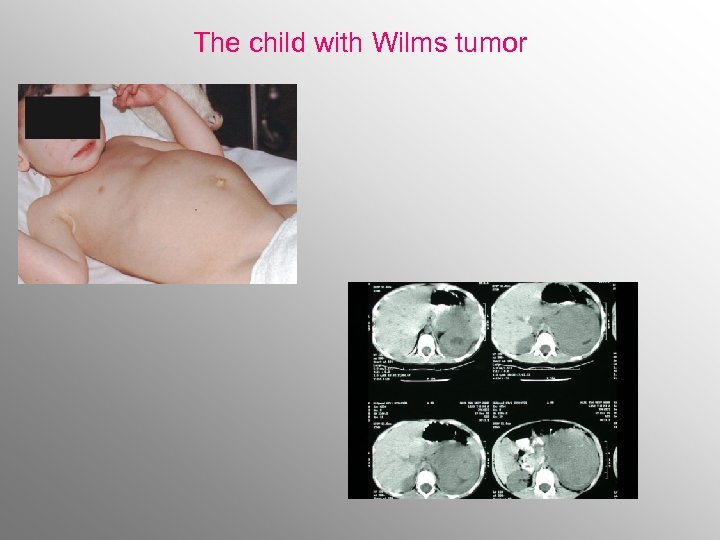 The child with Wilms tumor 