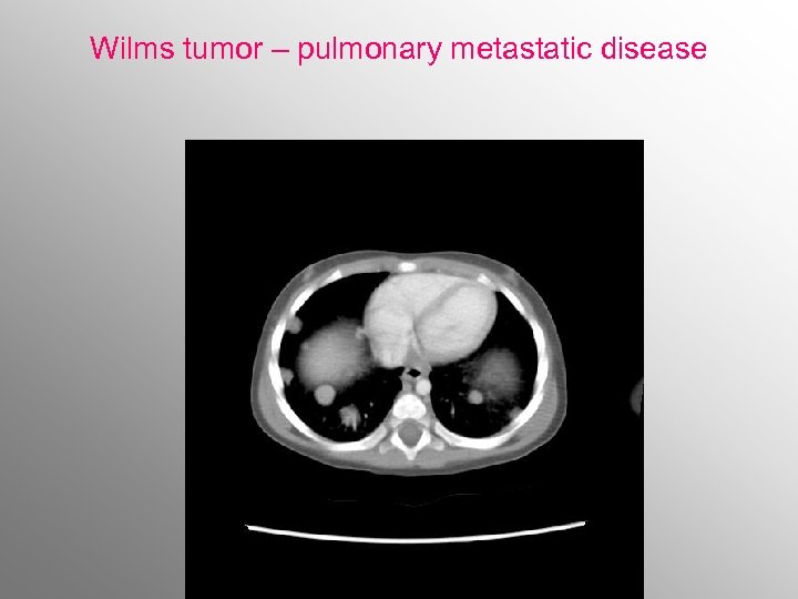 Wilms tumor – pulmonary metastatic disease 