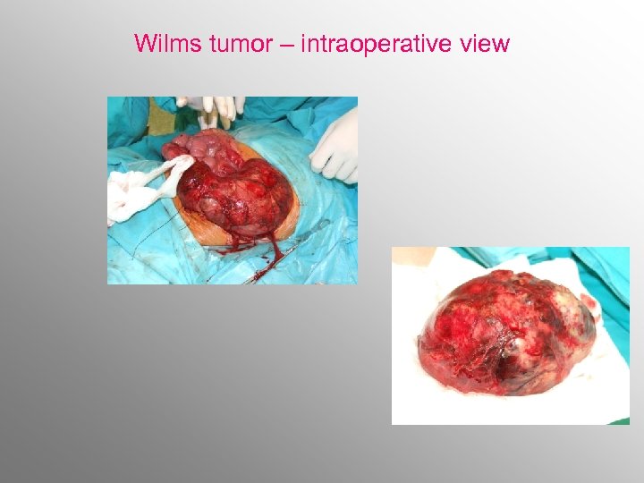 Wilms tumor – intraoperative view 
