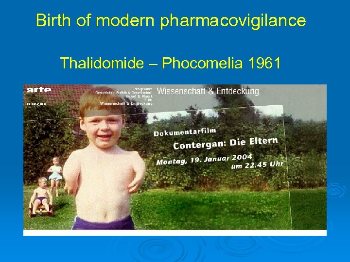 Birth of modern pharmacovigilance Thalidomide – Phocomelia 1961 