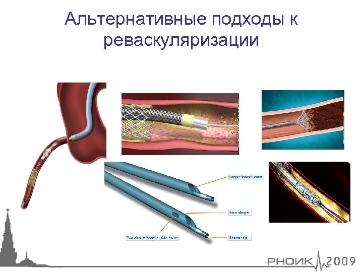 Альтернативные подходы к реваскуляризации 