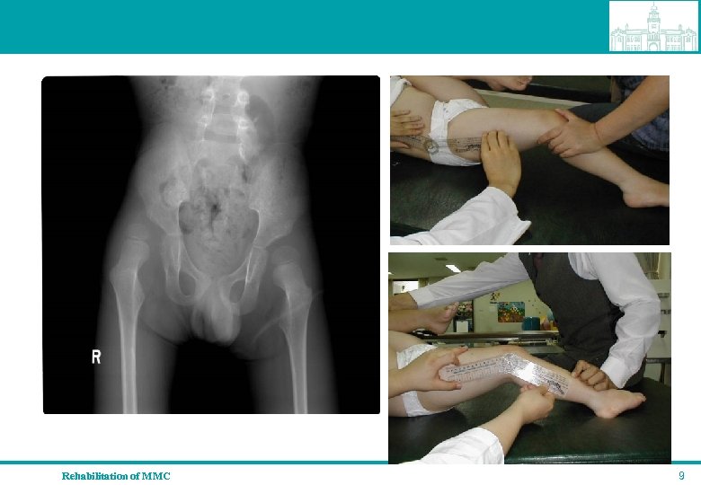Rehabilitation of MMC 9 