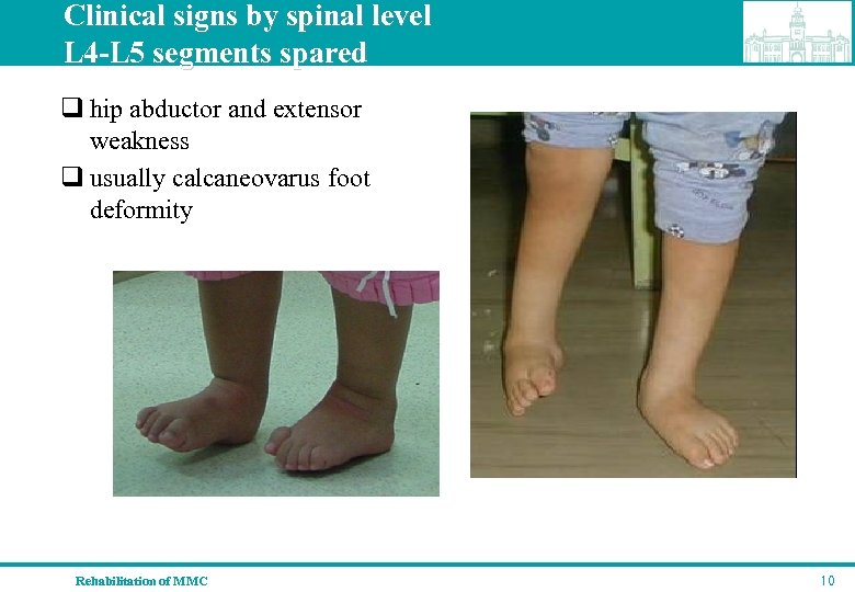Clinical signs by spinal level L 4 -L 5 segments spared q hip abductor