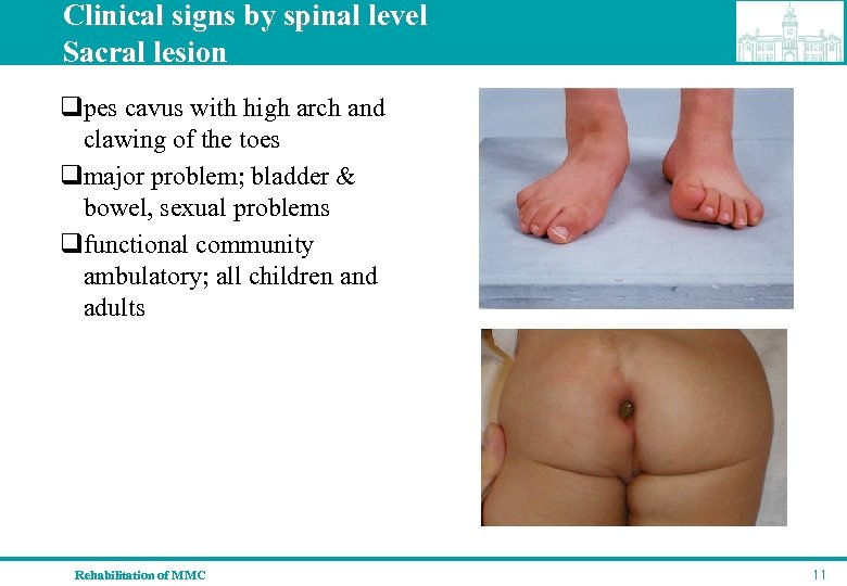 Clinical signs by spinal level Sacral lesion qpes cavus with high arch and clawing