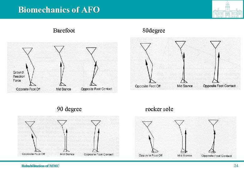 Biomechanics of AFO Barefoot 80 degree 90 degree rocker sole Rehabilitation of MMC 34