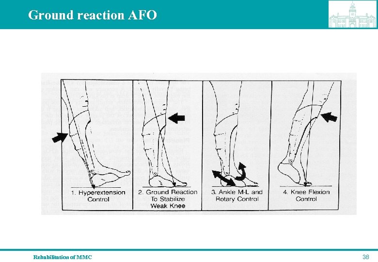 Ground reaction AFO Rehabilitation of MMC 38 