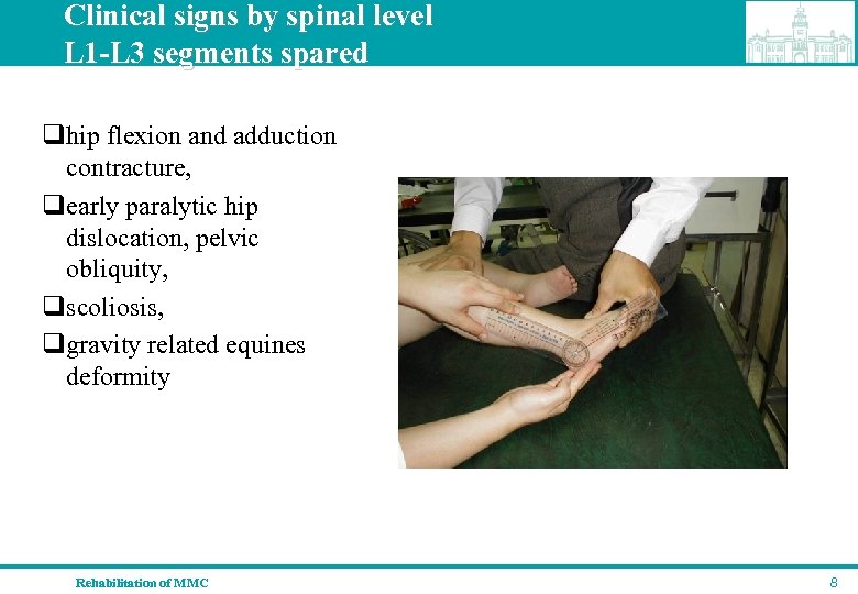 Clinical signs by spinal level L 1 -L 3 segments spared qhip flexion and