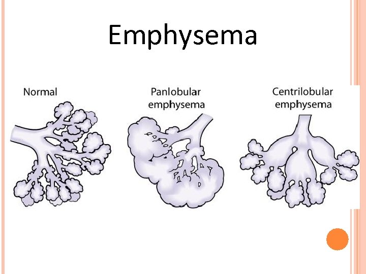 Emphysema 