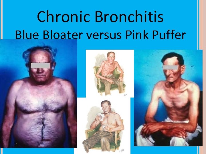 Chronic Bronchitis Blue Bloater versus Pink Puffer 