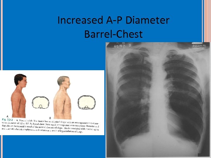 Increased A-P Diameter Barrel-Chest 