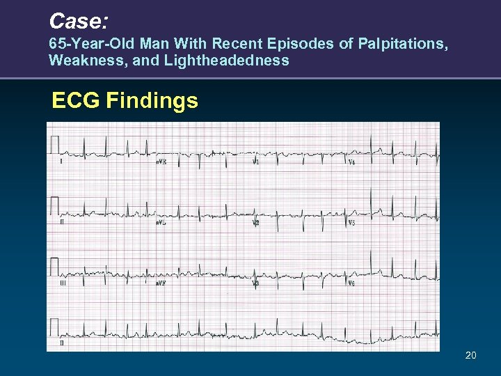 Case: 65 -Year-Old Man With Recent Episodes of Palpitations, Weakness, and Lightheadedness ECG Findings
