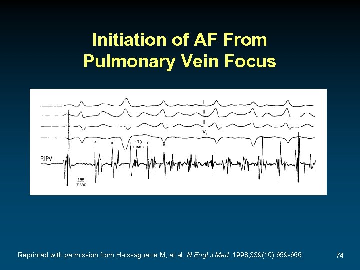 Initiation of AF From Pulmonary Vein Focus Reprinted with permission from Haissaguerre M, et