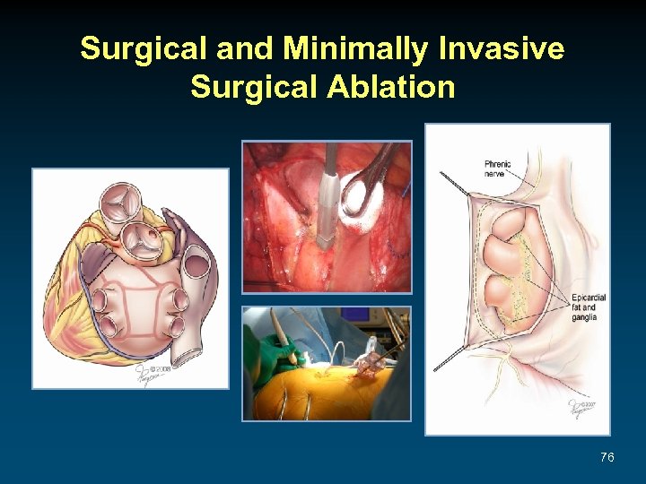 Surgical and Minimally Invasive Surgical Ablation 76 
