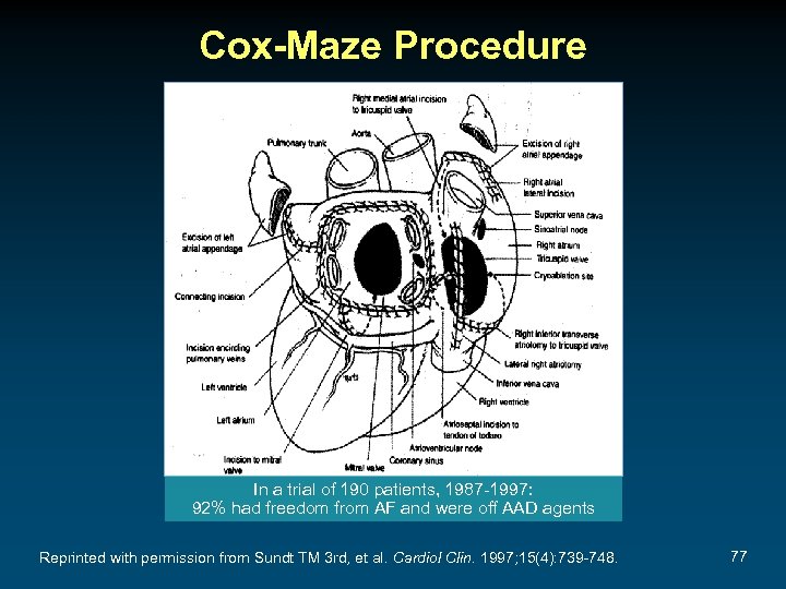 Cox-Maze Procedure In a trial of 190 patients, 1987 -1997: 92% had freedom from