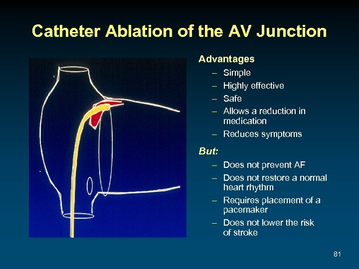 Catheter Ablation of the AV Junction Advantages – – Simple Highly effective Safe Allows