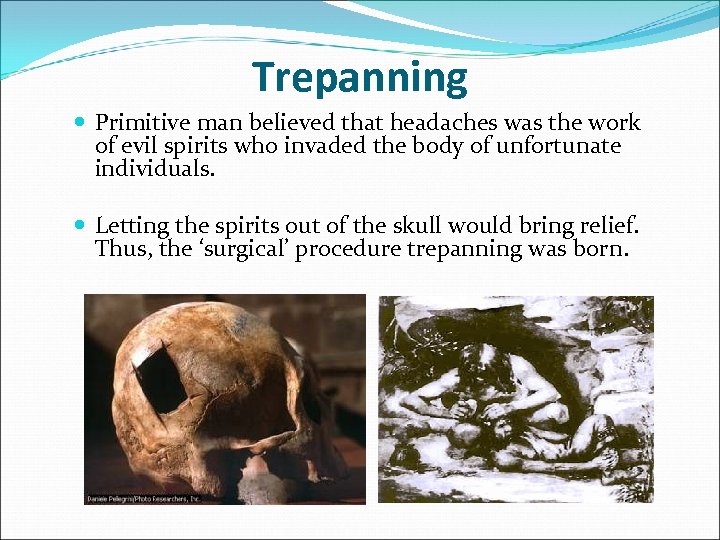 Trepanning Primitive man believed that headaches was the work of evil spirits who invaded