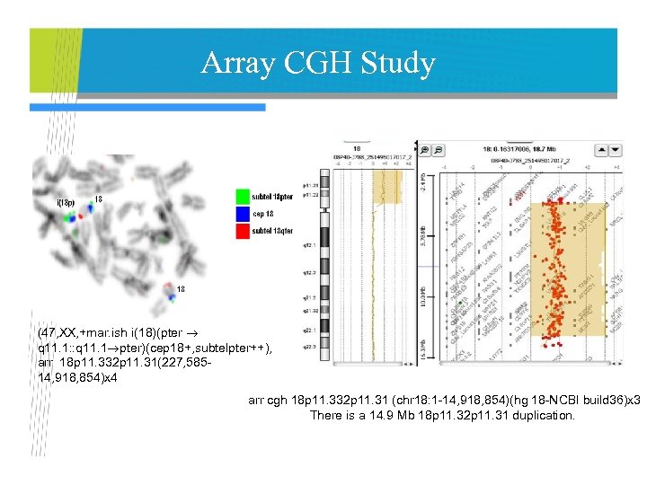 Array CGH Study (47, XX, +mar. ish i(18)(pter q 11. 1: : q 11.