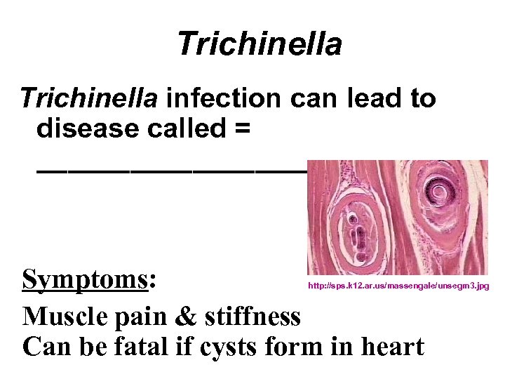 Trichinella infection can lead to disease called = _________ Symptoms: Muscle pain & stiffness