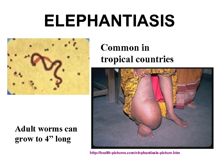 ELEPHANTIASIS Common in tropical countries Adult worms can grow to 4” long http: //health-pictures.