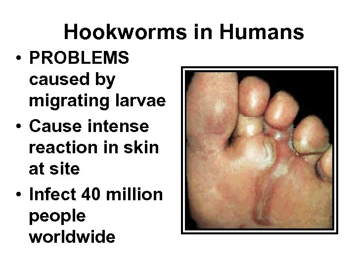 Hookworms in Humans • PROBLEMS caused by migrating larvae • Cause intense reaction in