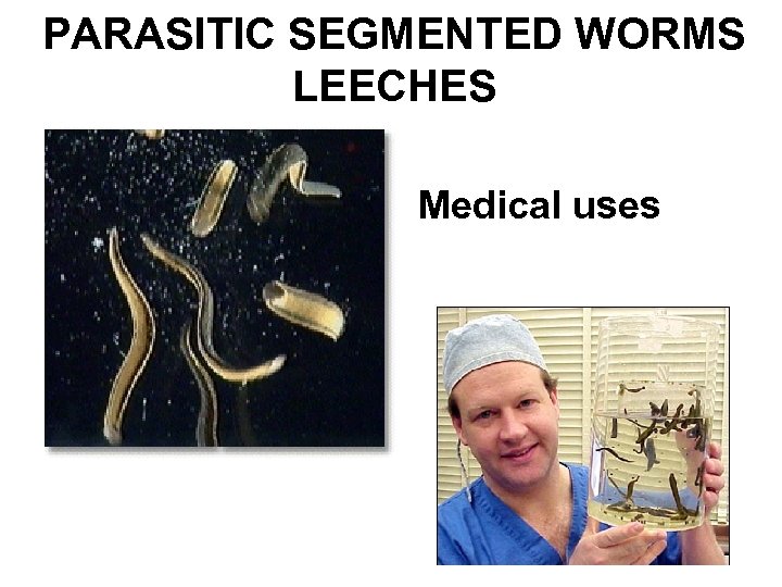 PARASITIC SEGMENTED WORMS LEECHES Medical uses 