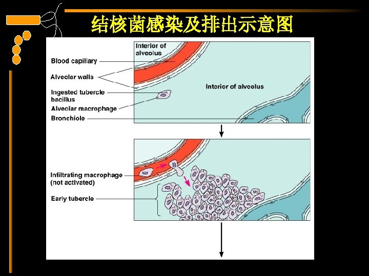 结核菌感染及排出示意图 