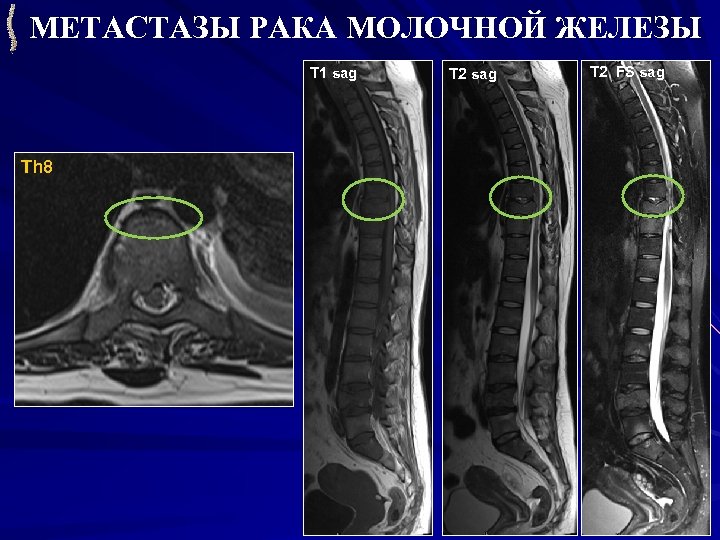 МЕТАСТАЗЫ РАКА МОЛОЧНОЙ ЖЕЛЕЗЫ T 1 sag Th 8 T 2 sag T 2