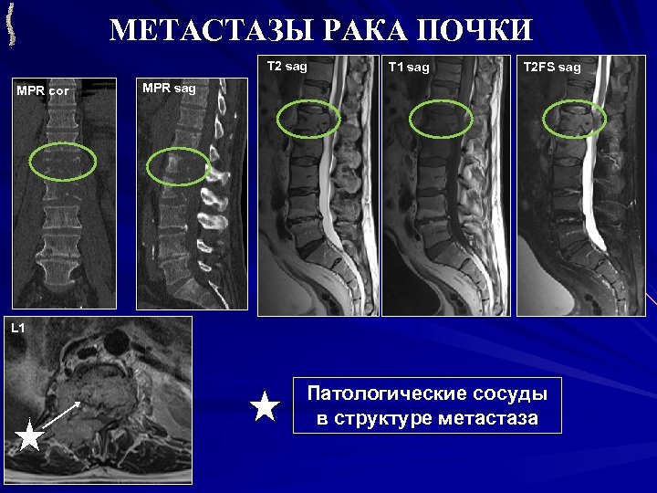 МЕТАСТАЗЫ РАКА ПОЧКИ T 2 sag MPR cor T 1 sag T 2 FS