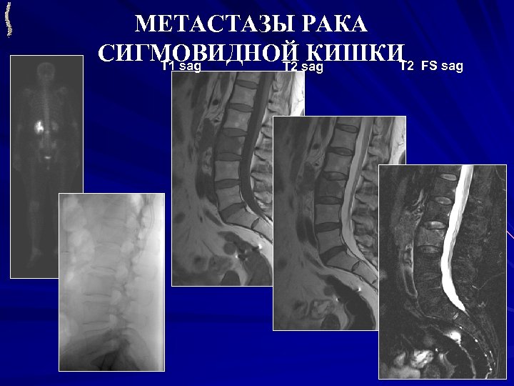 МЕТАСТАЗЫ РАКА СИГМОВИДНОЙ sag КИШКИ FS sag T 1 sag T 2 