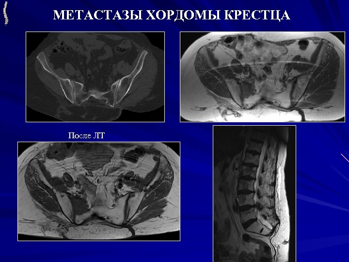 Кт крестца. Хордома затылочной кости. Хордома крестца рентген.