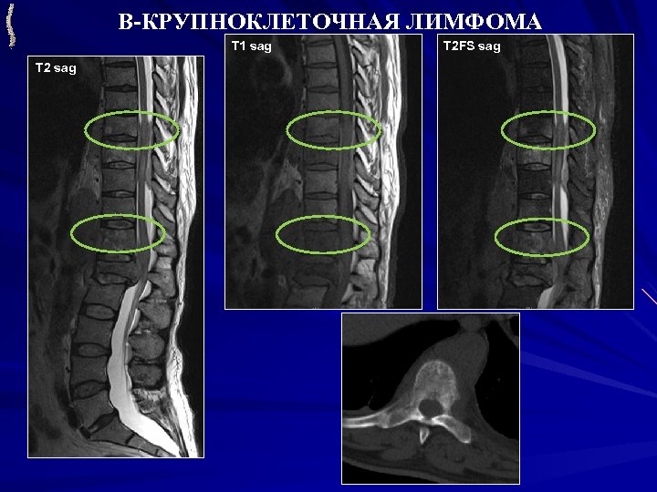 В-КРУПНОКЛЕТОЧНАЯ ЛИМФОМА T 1 sag T 2 FS sag 