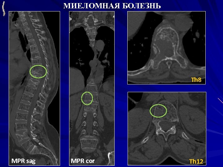 Миеломная болезнь фото больных