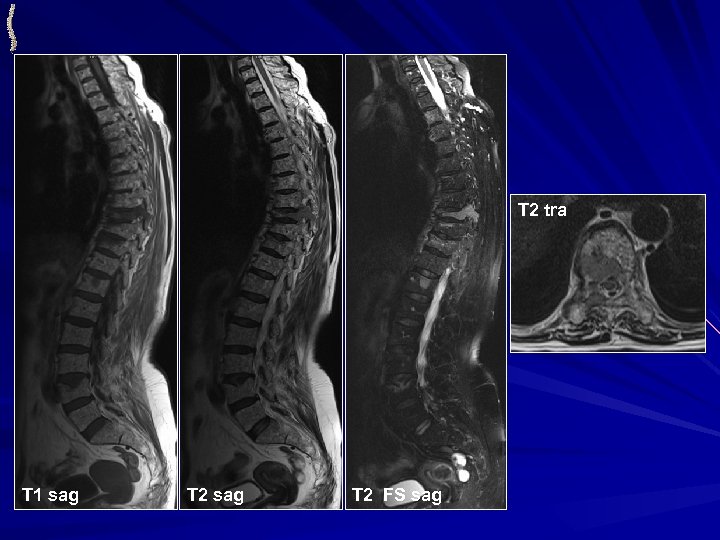 T 2 tra T 1 sag T 2 FS sag 