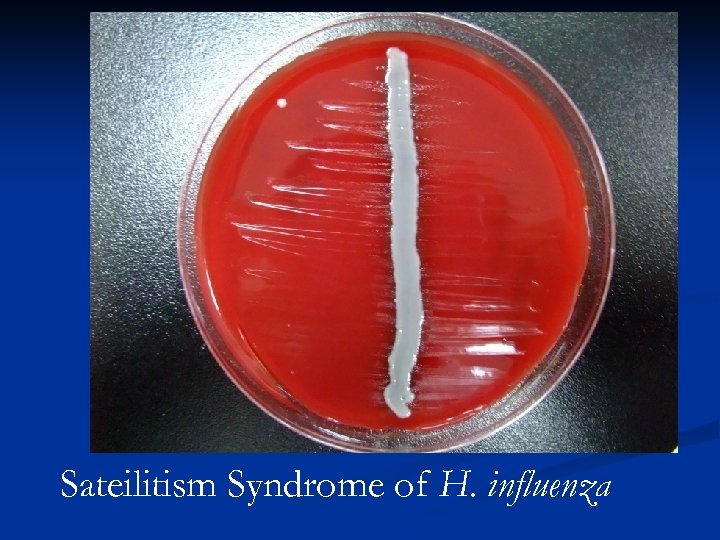 Sateilitism Syndrome of H. influenza 