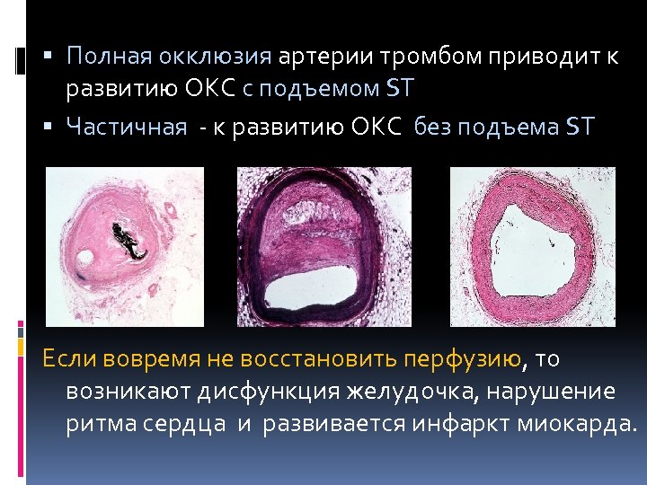  Полная окклюзия артерии тромбом приводит к развитию ОКС с подъемом ST Частичная -