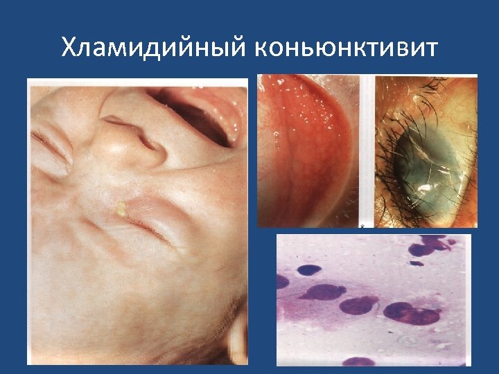 Хламидийный коньюнктивит 
