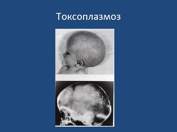 Токсоплазмоз 