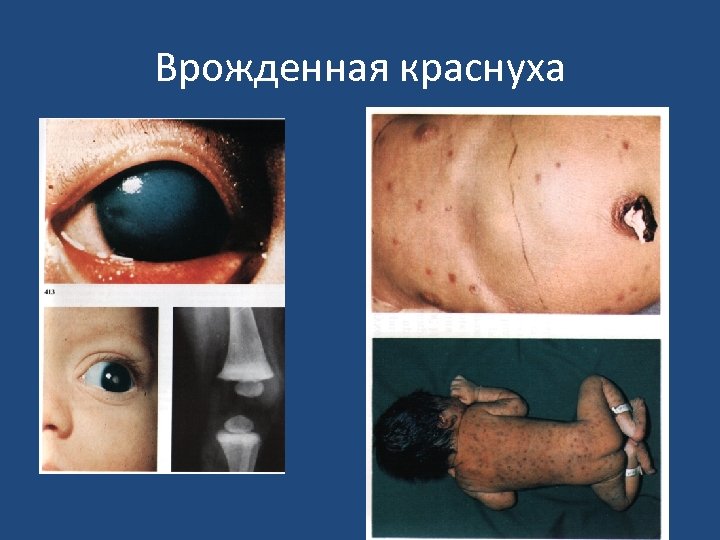 Врожденная краснуха 