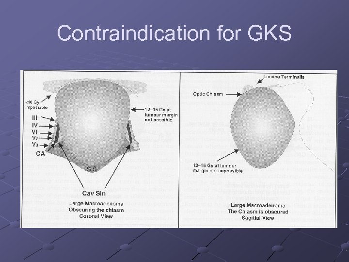 Contraindication for GKS 