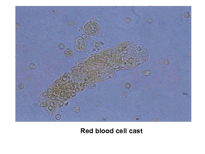 Red blood cell cast 