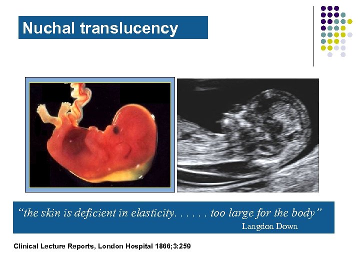 Nuchal translucency “the skin is deficient in elasticity. . . too large for the