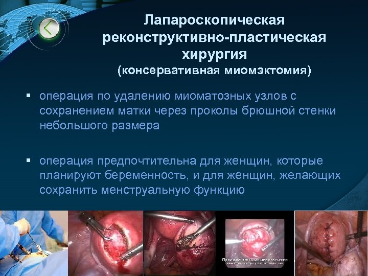 Лапароскопическая реконструктивно-пластическая хирургия (консервативная миомэктомия) § операция по удалению миоматозных узлов с сохранением матки