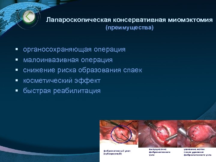 Лапароскопическая консервативная миомэктомия (преимущества) § § § органосохраняющая операция малоинвазивная операция снижение риска образования