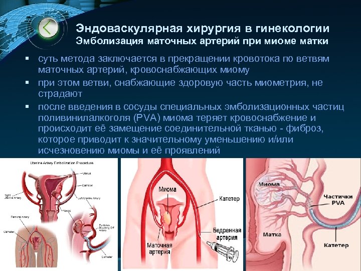 Эндоваскулярная хирургия в гинекологии Эмболизация маточных артерий при миоме матки § суть метода заключается