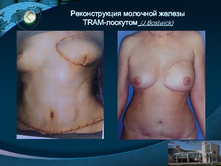 Реконструкция молочной железы TRAM-лоскутом (J. Bostwick) LOGO www. themegallery. com 