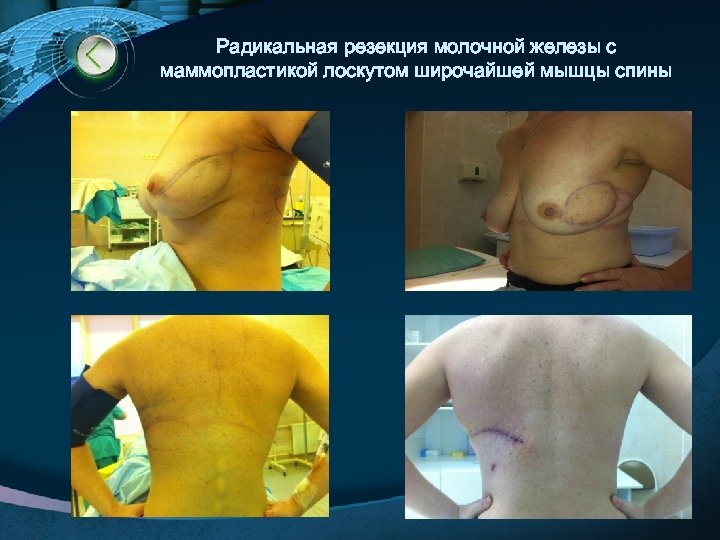 Радикальная резекция молочной железы с маммопластикой лоскутом широчайшей мышцы спины LOGO www. themegallery. com