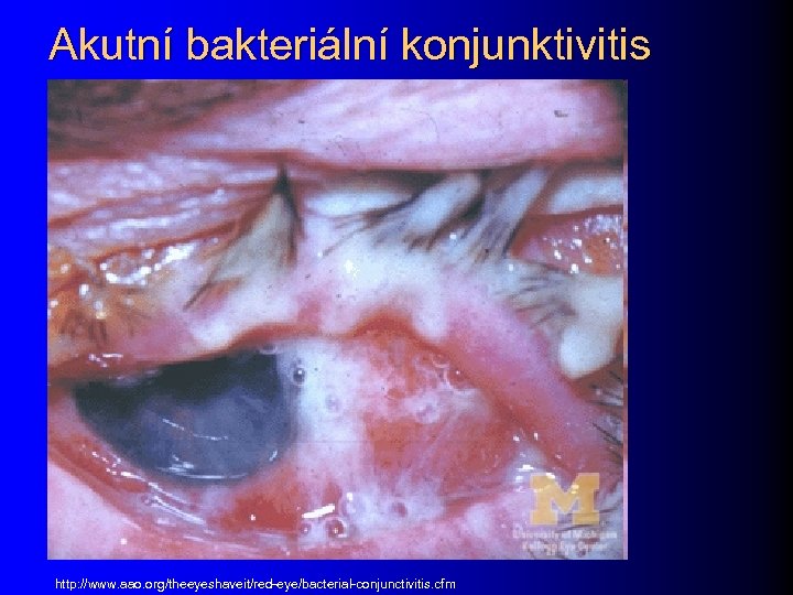 Akutní bakteriální konjunktivitis http: //www. aao. org/theeyeshaveit/red-eye/bacterial-conjunctivitis. cfm 